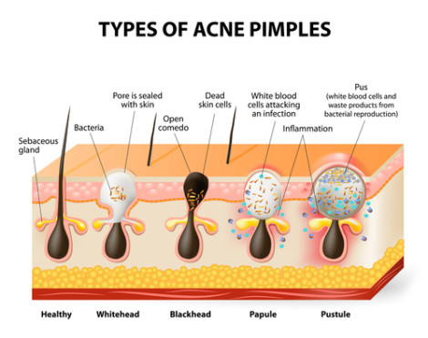 acne 